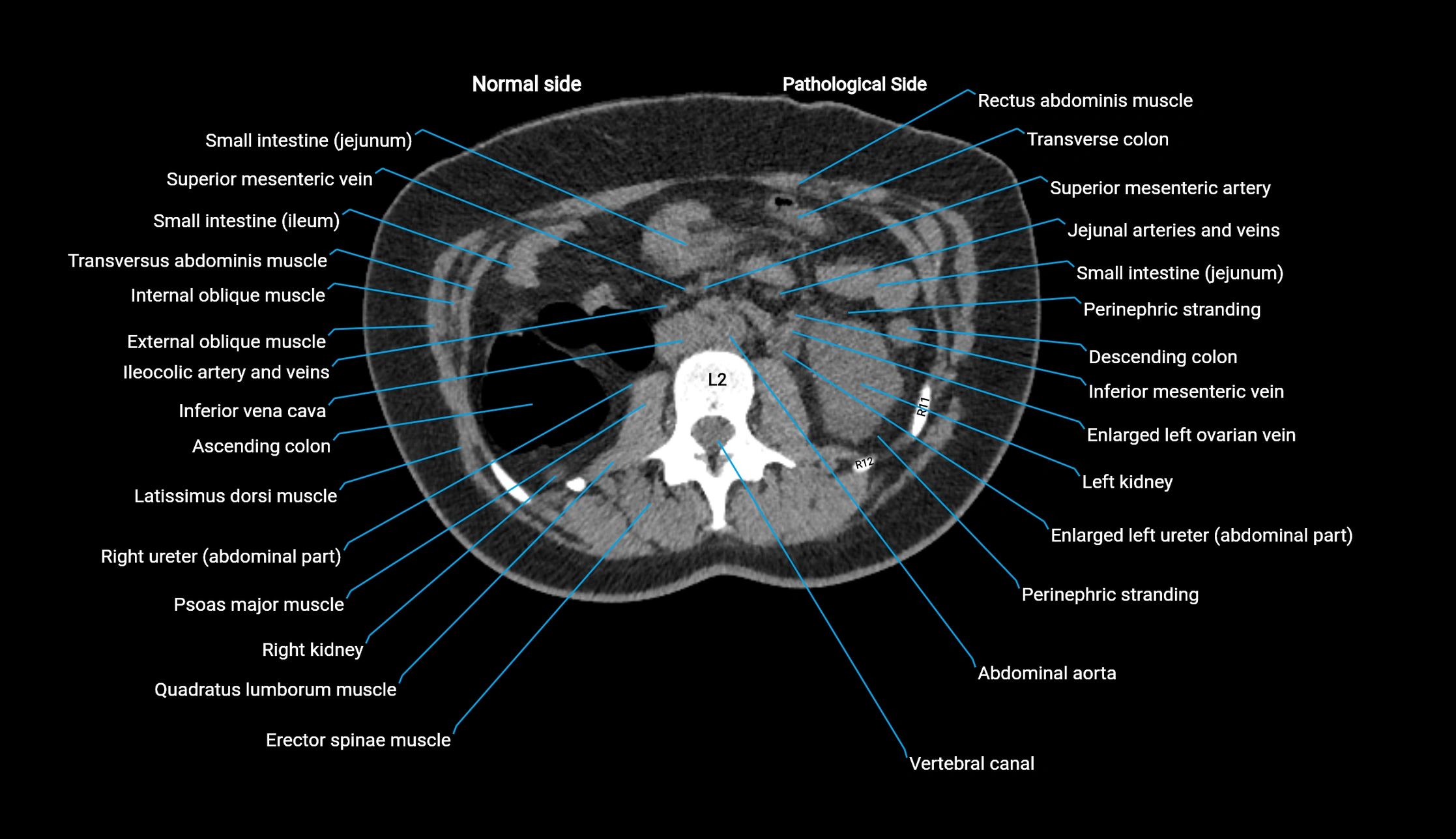 CT KUB axial cross sectional anatomy  radiology image -img-00201-00058.webp